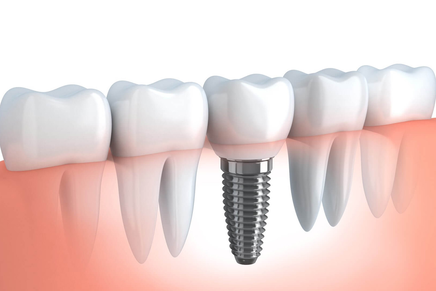 La microscopie électronique de table offre un label de qualité pour les implants dentaires